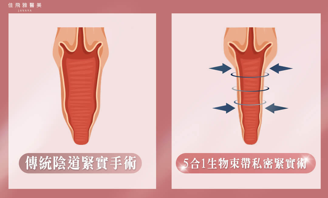 五合一生物束帶私密處緊縮術-傳統陰道緊實手術VS五合一生物束帶私密緊實術 | 佳飛雅醫美